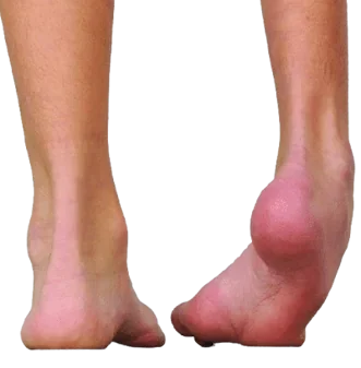 Çarpık Ayak – Pes Equinovarus