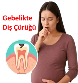Gebelikte Diş Çürüğü: Riskler ve Önleme
