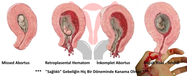  Her Kadın Düşük Yapar!