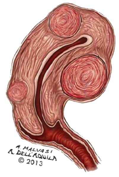 Miyom Cinsel İlişkiyi Etkiler Mi ?