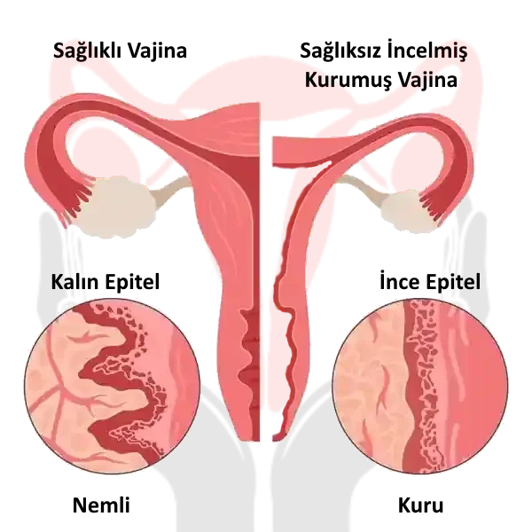 Vajina Yaşlanması | Vajinal Atrofi | Vajinanın İncelmesi