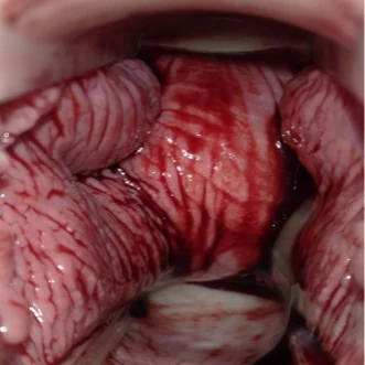 Rahi̇m & Vaji̇nal Kanamalar Beklemekle İyi̇leşir Mi ?