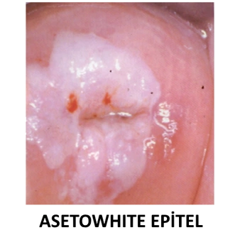 ASETOWHİTE EPİTEL - KOLPOSKOPİ