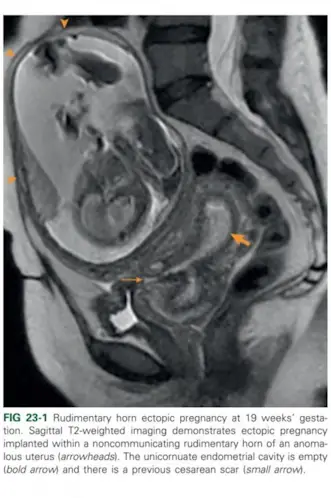 Karın içinde gelişmiş büyük fetus, abdominal gebelik
Dış Gebelik Muğla