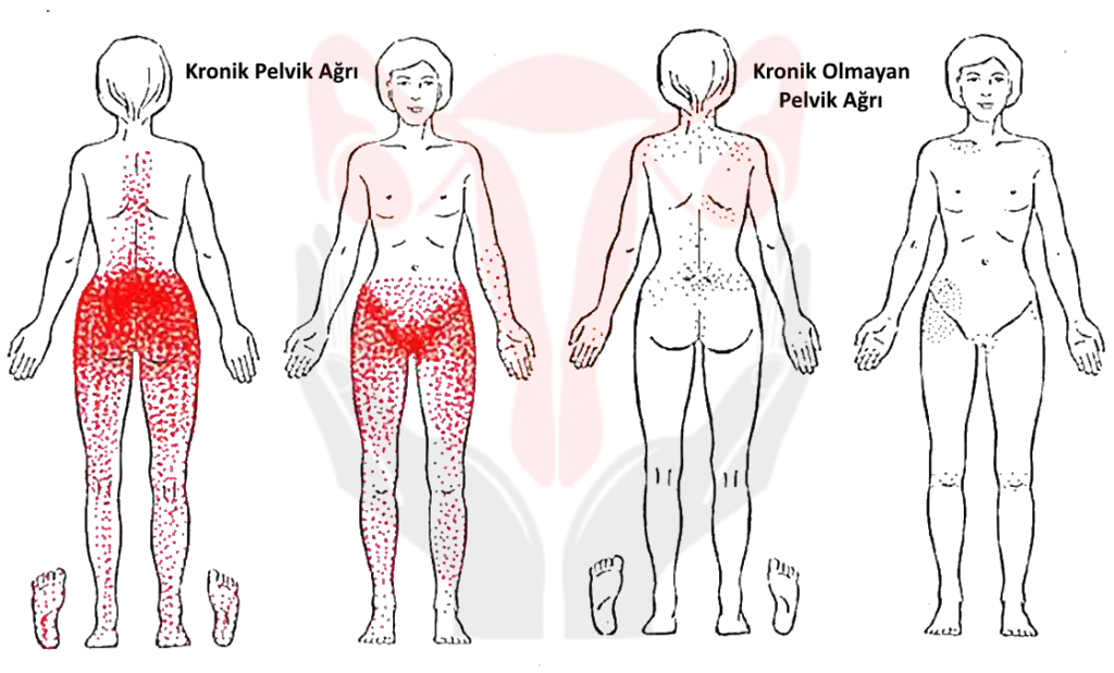 Sol taraf kronik pelvik ağrı, sağ taraf kronik olmayan durumlar için;
Sol taraf kronik pelvik ağrı, sağ taraf kronik olmayan durumlar için;
Kadınlarda yansıyan ağrı noktaları