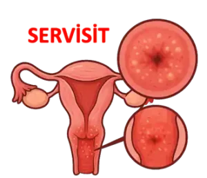 rahim ağzı iltihabı, servisit YOĞUN AKINTI