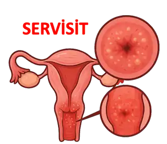 Rahim Ağzı İltihabı | Serviks İltihabi | Servisit