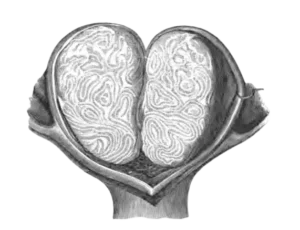 rahim-icini-tamamen-dolduran-rahimi-eriten-miyom