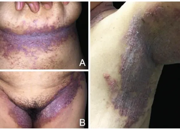 64 yaşında kadın, ailesinde de Hailey–Hailey Hastalığı mevcut