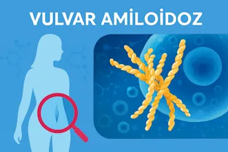 Vulvar Amiloidoz