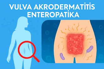 Vulvar Akrodermatitis Enteropatika