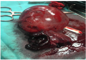 Ovarian Torsiyon nedeniyle alınmış over görülen yoğun pıhtılar !, eğer torsiyon açılsaydı bu pıhtılar krtik organlara atacaktı