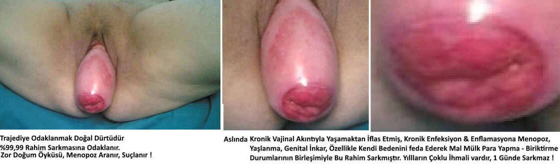 rahim sarkmasının temelleri sebepleri Muğla kadın doğum doktor