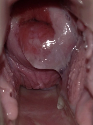 servikal kanal yetmezliği - servikal mukus reflüsü