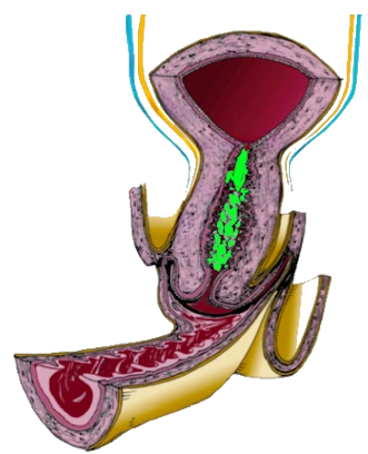 servikal mukus servikal kanal yeni