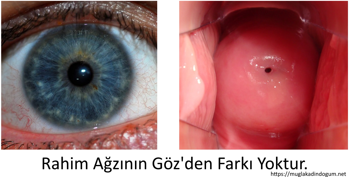 emmet-yirtigi-rahim-agzi-yirtigi-serviks-goz-iliskisi-тАУ-mugla-kadin-dogum-doktoru