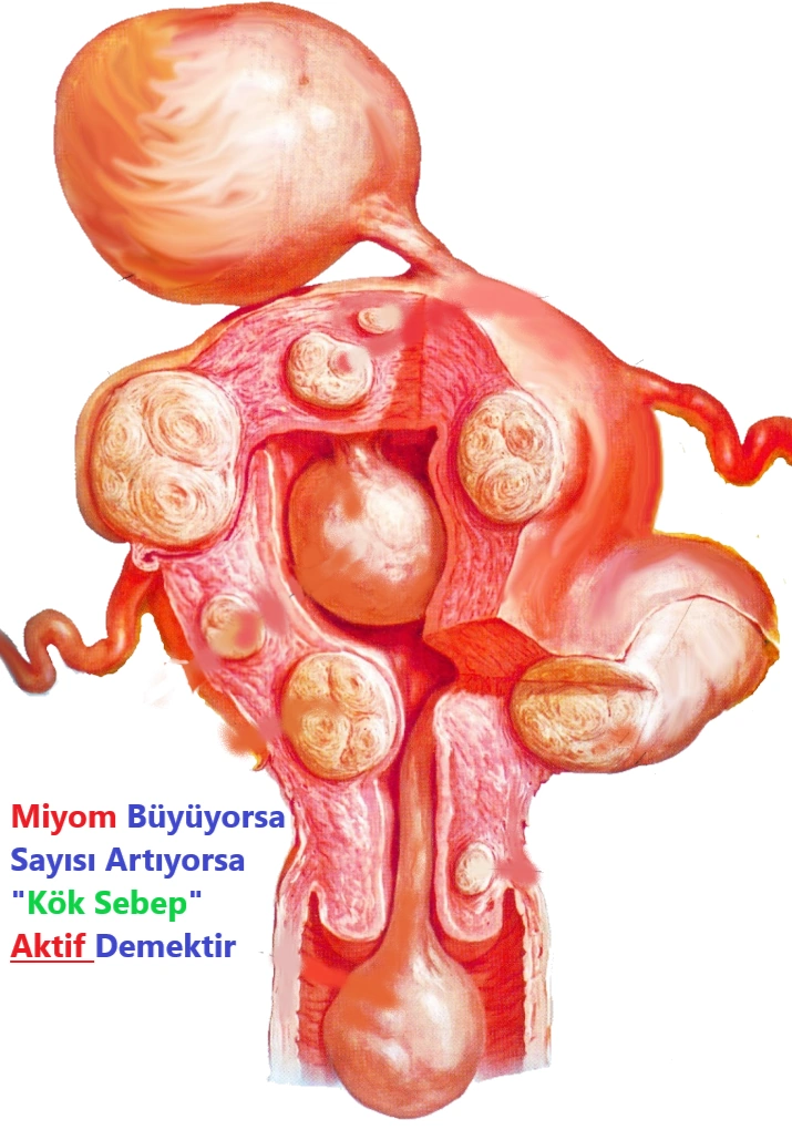 miyoma uteri rahimi miyom kaplaması miyom ur gebelikte leiyomyoma Muğla kadın doğum