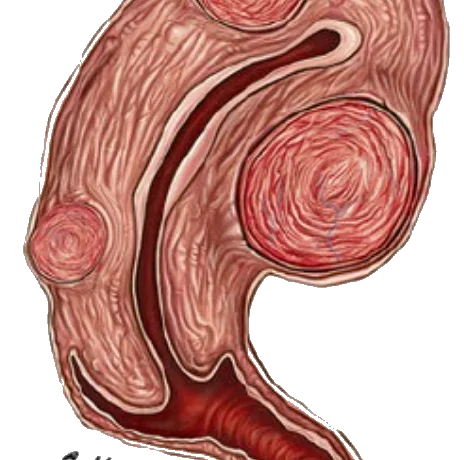 Miyom-Tedavisi-Mugla-Kadin-Doktoru-05467740159