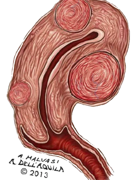 Miyom Cinsel İlişkiyi Etkiler Mi ?