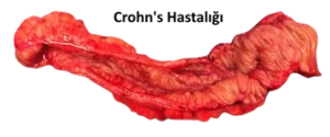 Inflamatuar-barsak-hastaligi-Crohns-Hastaligi-Mugla-kadin-dogum-doktoru
