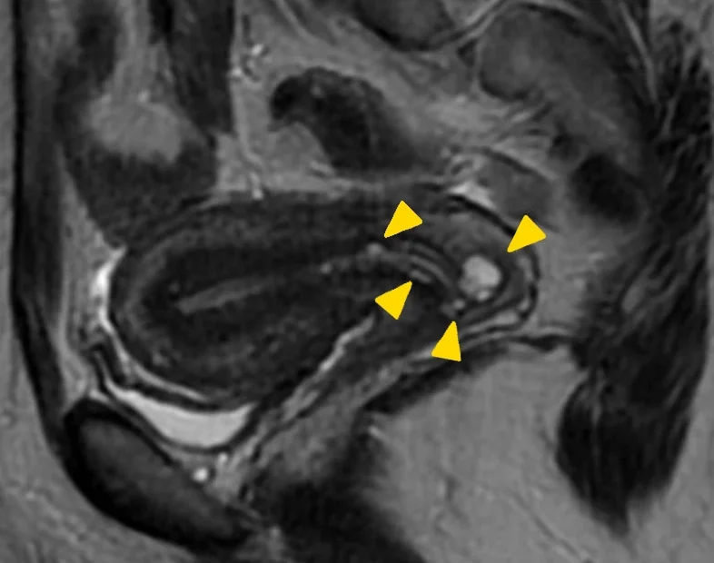 Nabouth Kisti – Rahim Ağzı Kisti