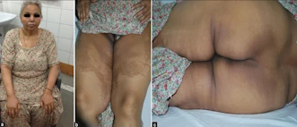 Güneş maruziyeti sonrası bowen hastalığı