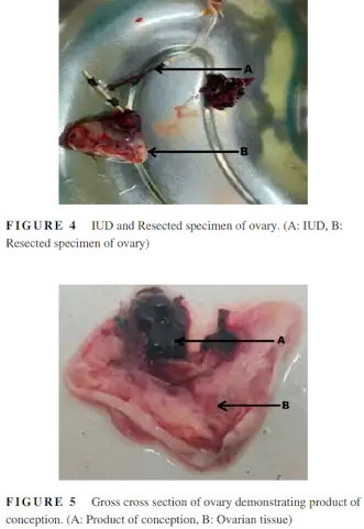 yumurtalikta-spiral-mugla-kadin-dogum