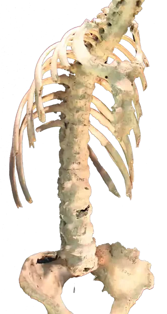 Ankilozan Spondilit – Muğla Kadın Doğum