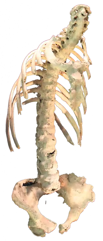 Ankilozan Spondilitin omurgayı dejenere etmesi kronik bir süreçtir. kadınlar etkilenmektedir