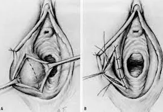 Cerrahi Drenaj + Marsupializasyon