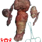 Rahim-buyumesi-Rahim-alinmasi-ameliyati-histerektomi-kronik-enflamasyonlu-rahim-Mugla-kadin-dogum-Mesut-Bayraktar-14