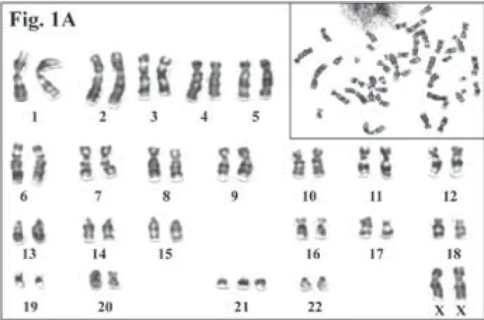 Trizomi 21: kadın birey