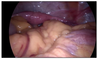 Turner Sendromu Neden Erkek Hastalığı Değil ?