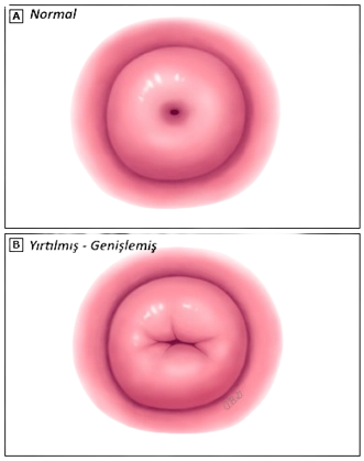 normal serviks ve yırtılmış serviks muğla kadın doğum doktor mesut bayraktar