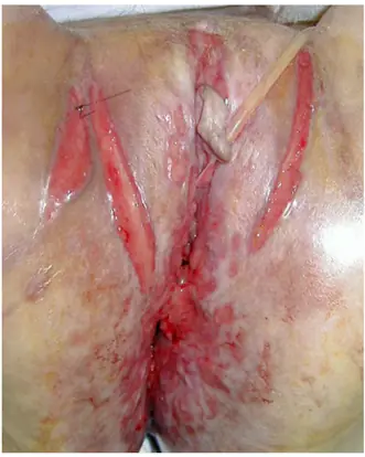  Bıçak kesiği şeklinde vulvar ülserler 