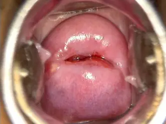 Doğum yapmış kadında, geniş aralıklı veya enine yarık bir dış os ile şekillenmiş olabilir.