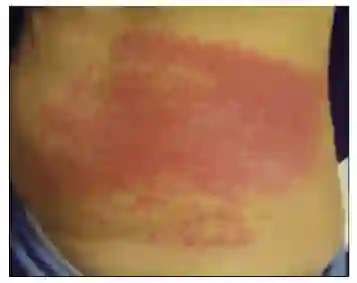 Pseudomonas aeruginosa cilt döküntüsüKadınlarda Suyla Bulaşan Hastalıklar - Deniz & Havuz