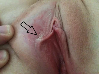 Yavaş Yavaş Oluşmaya Başlamış Vulvar Smegmatis - Kadın Vulvar Depozitlenme