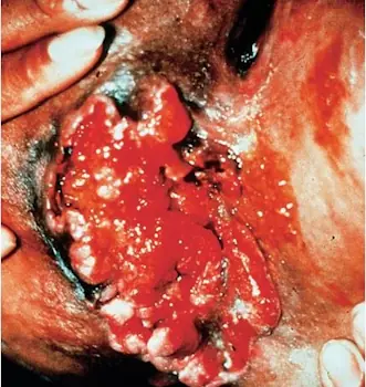 Vulvar amebiazis