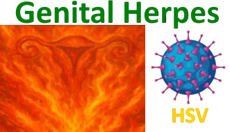 Genital Herpes – Vulvar Herpes – HSV
