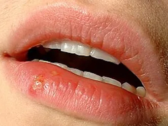 herpes labialis - uçuk - muğla kadın doğum