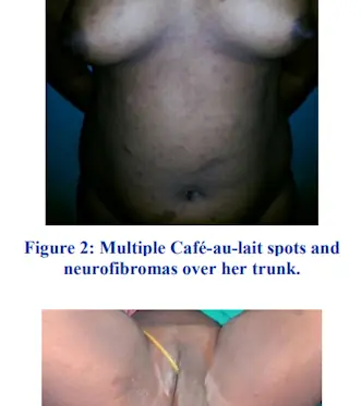 Vucutta cafe-au-lait (sütlü kahve) lekeleri olduğunda vulvar şişlik durumunda nörofibramatozis tip 1 olabilir