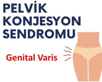 Pelvik Konjesyon Sendromu – Jinekoloji