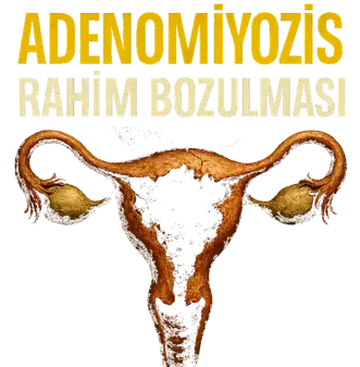 Adenomiyozis – Rahim Bozulması