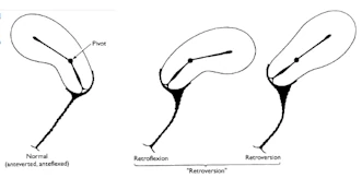 Normal Rahim & Anormal Rahim Durumu
Ters Rahim; Rahim Yaş İken Eğilir