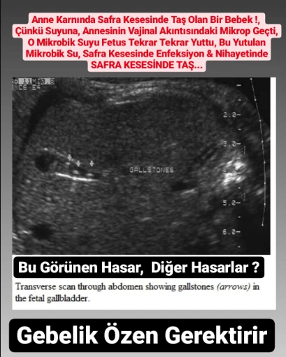 Anne Karnında Safra Kesesinde Taş Olan Bir Bebek !Çünkü Suyuna, Annesinin Vajinal Akıntısındaki Mikrop Geçti,
O Mikrobik Suyu Fetus Tekrar Tekrar Yuttu, Bu Yutulan Mikrobik Su, Safra Kesesinde Enfeksiyon & Nihayetinde SAFRA KESESİNDE TAŞ...
Bu Görünen Hasar, Ya  Diğer Hasarlar ?
Gebelik özen GerektirirBebeğin Hamilelikteki Hareketleri 