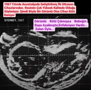 1967 Yılında Avustralyada Geliştirilmiş İlk Ultrason Cihazlarından, Resimin Çok Yüksek Kalitede Olduğu Söyleniyor. Şimdi Böyle Bir Görüntü Olsa Cihaz Kötü Deniyor
