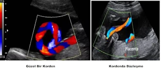 Normal kordon, kordonda düzleşme