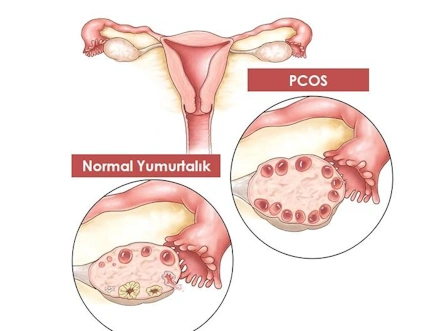 polikistik over sendromu