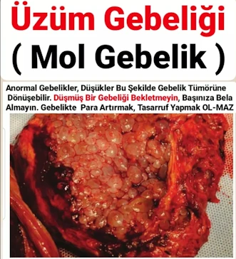Üzüm Gebeliği ( Mol Gebelik )
Anormal Gebelikler, Düşükler Bu Şekilde Gebelik Tümörüne Dönüşebilir. Düşmüş Bir Gebeliği Bekletmeyin, Başınıza Bela Almayın. Gebelikte Para Artırmak, Tasarruf Yapmak OL-MAZ.
Muğla Kadın Doğum